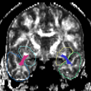 CaseD00938 tracts cut.png