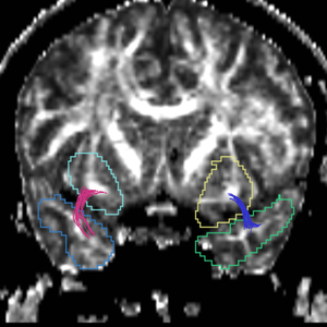 CaseD00917 tracts cut.png