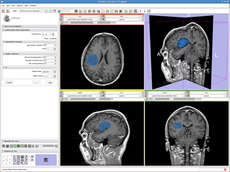 Segmentation of brain tumor