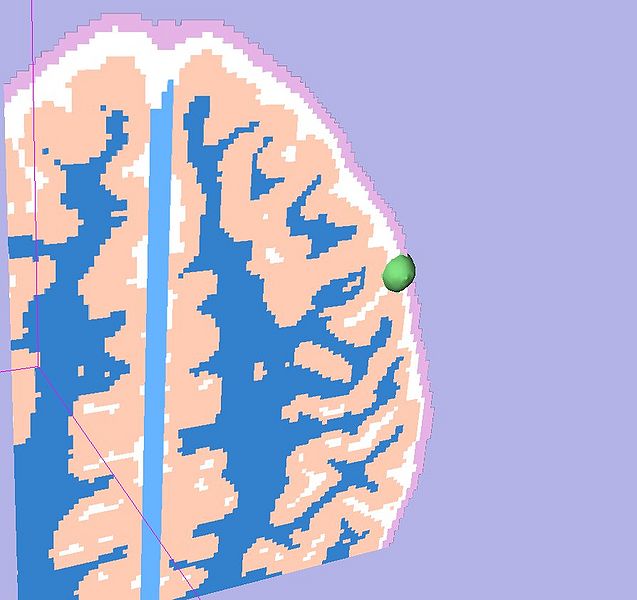 File:Tumor seed3 3dview.jpg