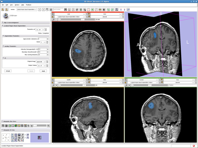 Segmentation of brain tumor