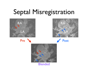 Septal MisReg CARMA.png