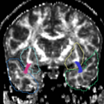 CaseD00939 tracts cut.png