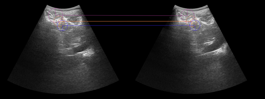 Preliminary Results: Features correspondences, Kidney Ultrasound Sweeps