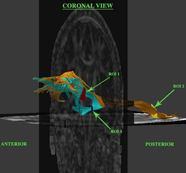 File:Frontotemporal tracts2.jpg