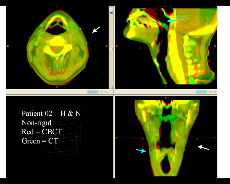 File:RadOnc HN2 deformable.png