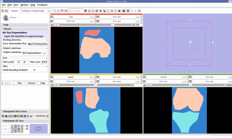 File:Femur Patella Tibia.jpg