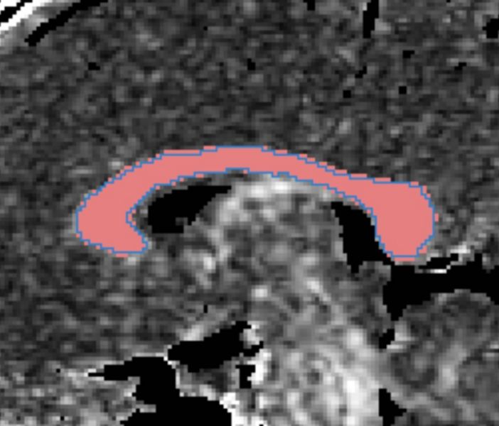 File:CaseD20 bothROIs0001.jpg