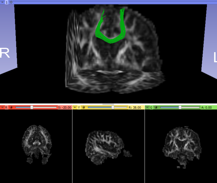 File:Chronic midcc FA.png