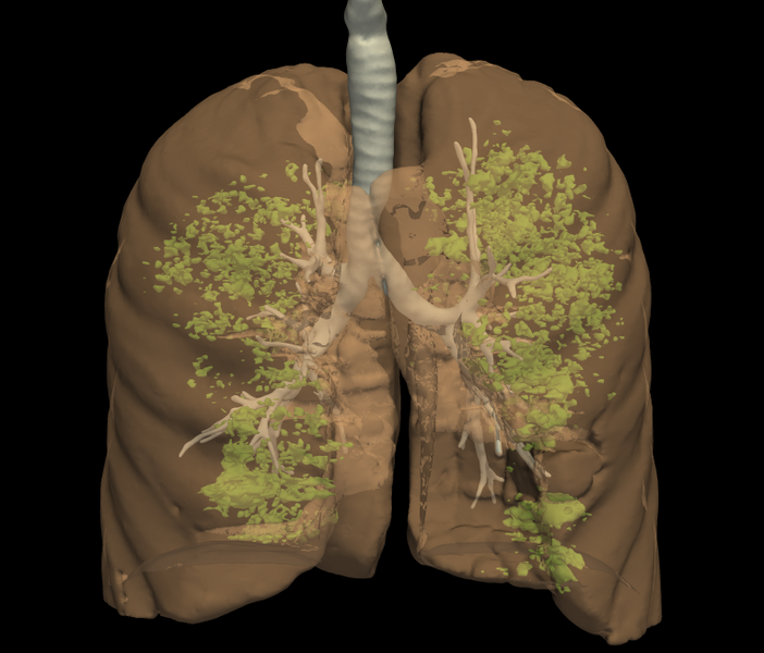 File:LungCover-LowRes.png