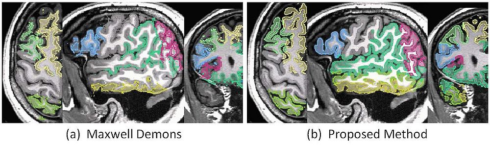 white matter to Atlas Registration Results