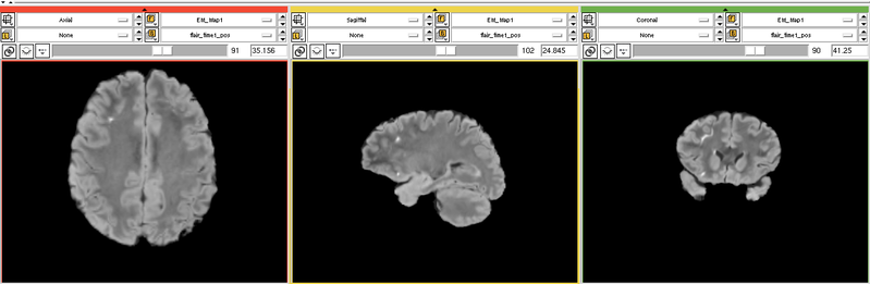 File:EMS LesionExp FLAIR.png