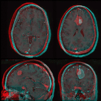 before/after registration, indiv. images in red/cyan, match in gray