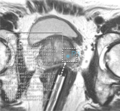 2015 Summer Project Week-Prostate mri.png