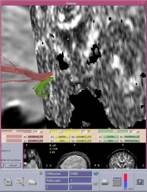 Frontotemporal tracts.jpg