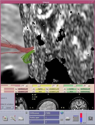 Frontotemporal tracts.jpg