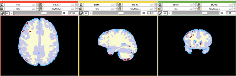 File:EMS LesionExp Segmentation.png