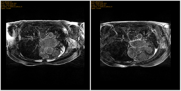 Lef) Pre ablation. Right) Post ablation.