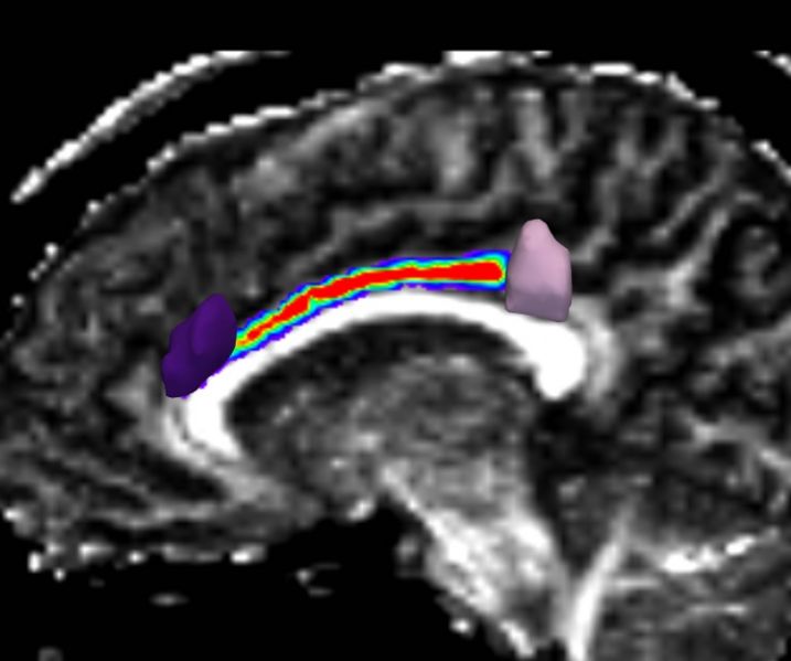 File:Cingulate gyrus.jpg