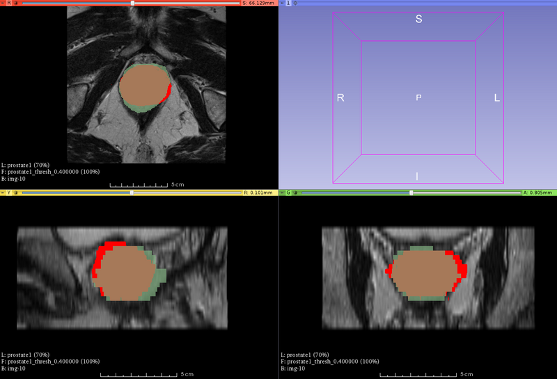 File:Plastimatch MAB prostate progess.png
