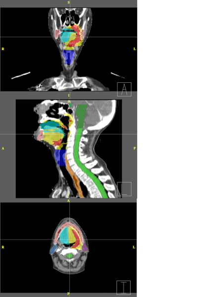 File:RadOnc HN seg.png
